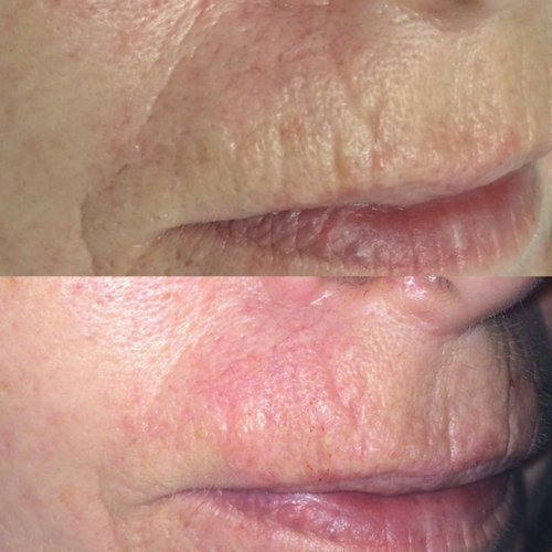 Lip lines before (top) and immediately after treatment