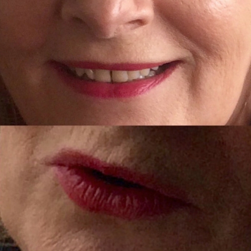 Hydroporation for peri-oral rejuvenation before (bottom) & after (top) course of 3