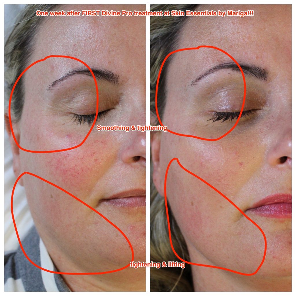 Before and after pics showing crows feet reduced jawline tightened and old acne scars smoothed. Treatment performed was trifractional resurfacing at Skin Essentials by Mariga, Wexford using the Divine Pro technology